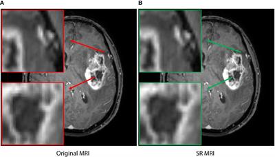A hybrid deep learning scheme for MRI-based preliminary multiclassification diagnosis of primary brain tumors